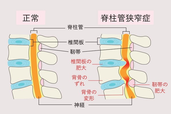 脊柱管狭窄症の骨のイラスト